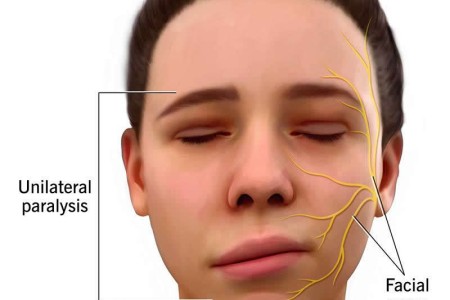 Facial Paralysis