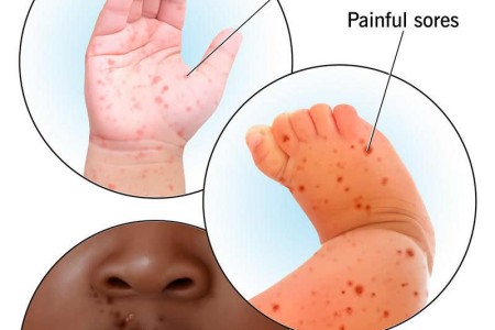 Hand, Foot and Mouth Disease