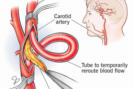 Carotid Endarterectomy