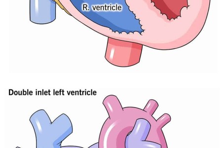 Double Inlet Left Ventricle