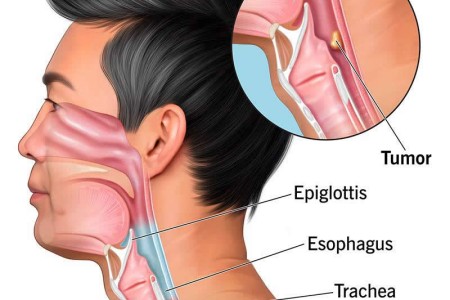 Hypopharyngeal Cancer