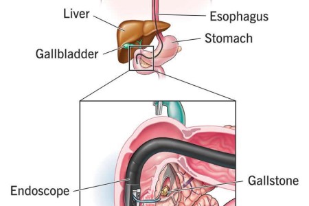 ERCP (Endoscopic Retrograde Cholangiopancreatography)