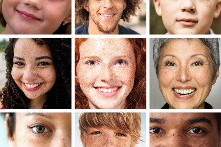 Freckles (Ephelides and Solar Lentigines)