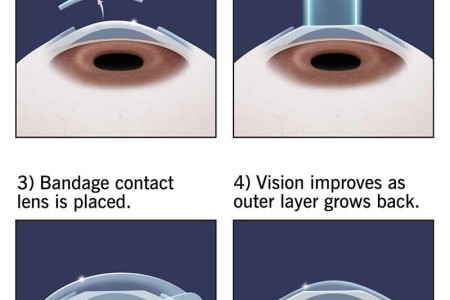 Photorefractive Keratectomy (PRK)