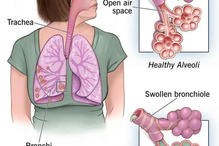 Pneumonia