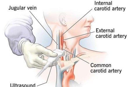 Carotid Ultrasound