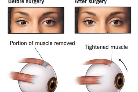 Strabismus Surgery