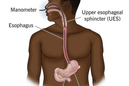 Esophageal Manometry Test