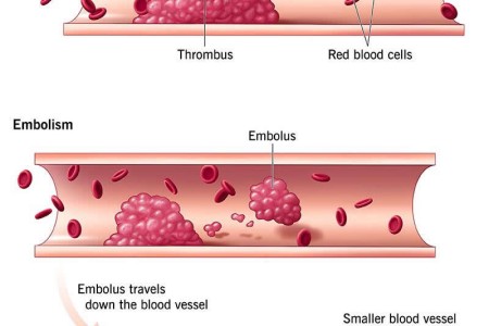 Thrombosis