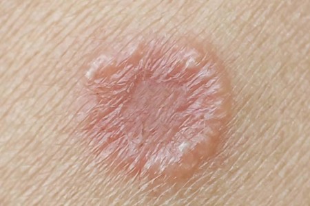 Tinea Manuum