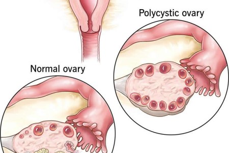 Polycystic Ovary Syndrome (PCOS)