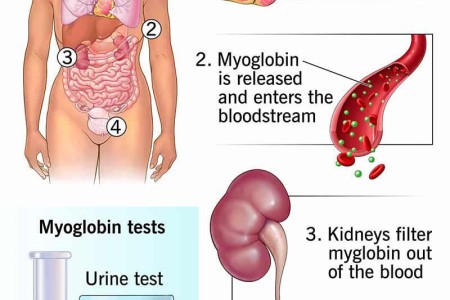 Myoglobin Test