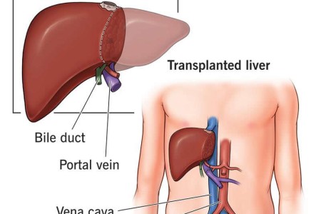 Living Liver Donor & Transplant