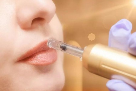 The Dangers of Hyaluron Pen Lip Fillers