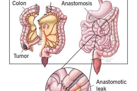 Anastomotic Leak