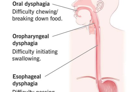 Dysphagia (Difficulty Swallowing)