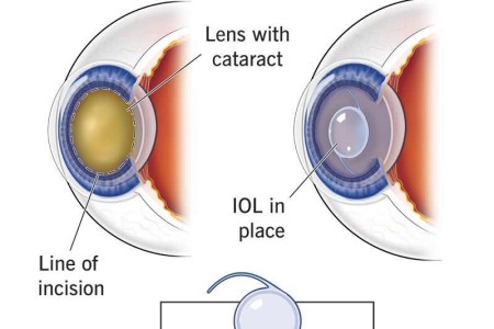 Cataract Surgery