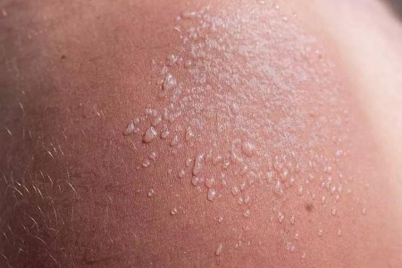 Burned and Blistering? When To See a Doctor for a Sunburn
