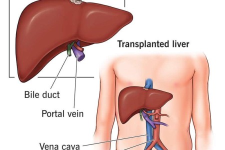 Liver Transplantation