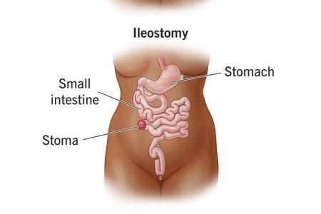Ostomy