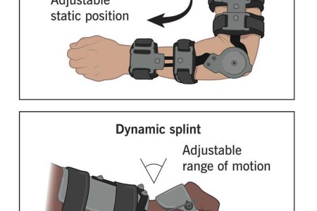 Splint