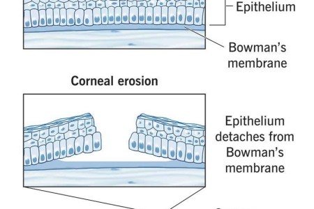 Recurrent Corneal Erosion
