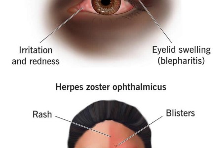 Ocular Herpes (Eye Herpes)