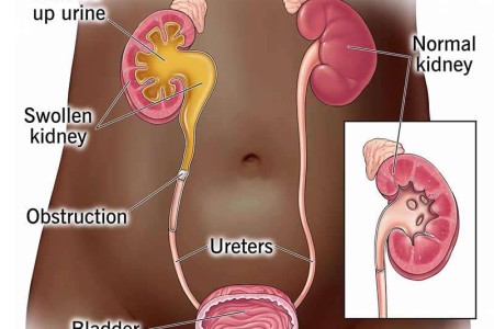 Hydronephrosis