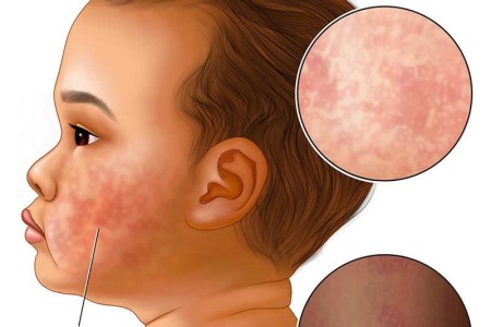 Fifth Disease