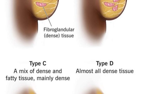 Dense Breast Tissue