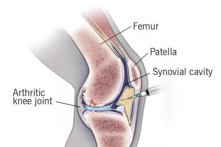 Knee Gel Injections (Viscosupplementation)