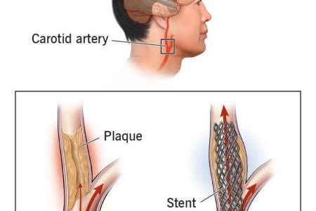 Carotid Artery Stenting