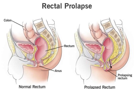 Rectal Prolapse