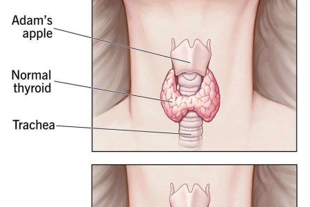 Thyroiditis
