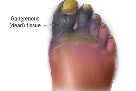 Gangrene
