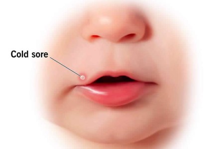 Cold Sores