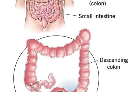 Flexible Sigmoidoscopy