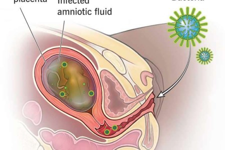 Chorioamnionitis