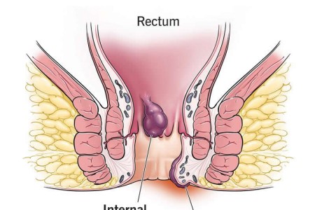 Hemorrhoids