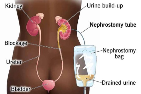 Nephrostomy Tube