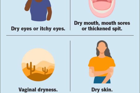 Sjögren's Syndrome