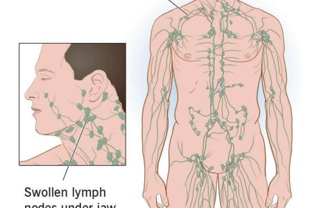 Swollen Lymph Nodes