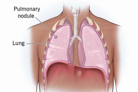 Pulmonary Nodules