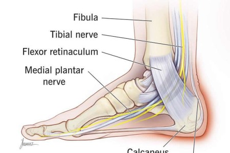 Heel Pain