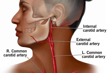 Carotid Artery