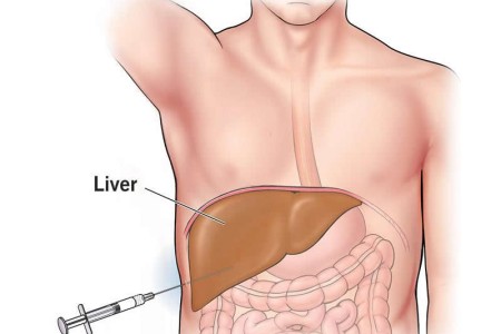 Liver Biopsy