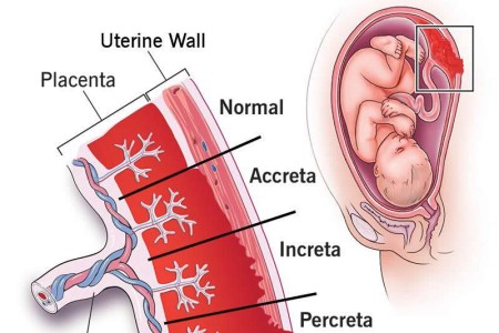 Placenta Accreta