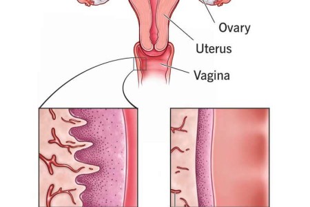 Vaginal Dryness