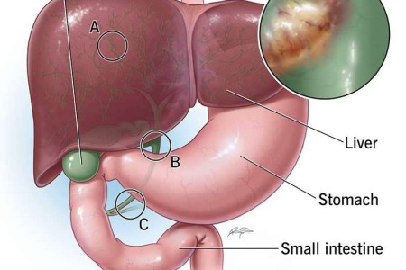 Cholangiocarcinoma (Bile Duct Cancer)