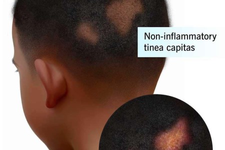 Tinea Capitis